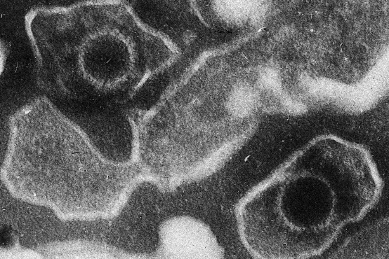 Широко распространенный вирус Эпштейна-Барр может вызывать рассеянный склероз