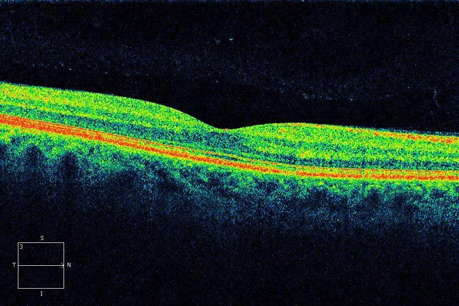 Окт глаза. Когерентная томография сетчатки. Оптическая когерентная томография норма. Оптическая когерентная томография сетчатки глаза. Когерентная томография сетчатки глаза норма.